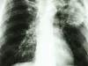 China Halves Its TB Problem