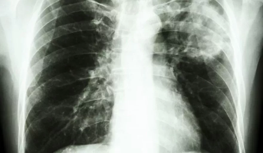 China Halves Its TB Problem